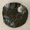 胃结石板 2